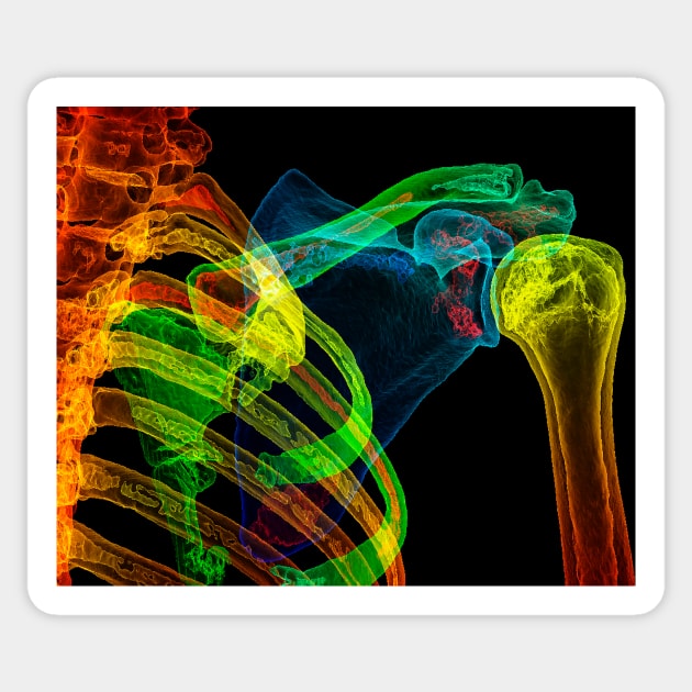Normal shoulder, 3D CT scan (C029/5201) Sticker by SciencePhoto